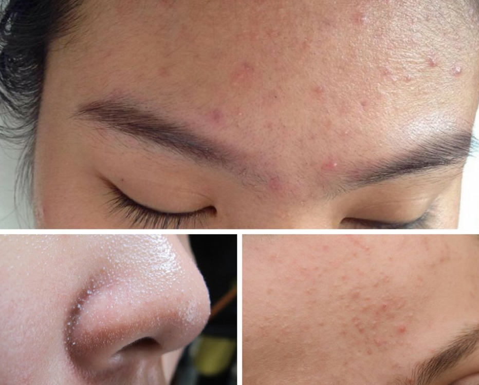 Trị Mụn Ẩn Và Mụn Cám Tại Sen Beauty